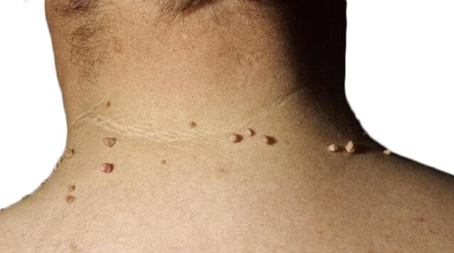 Papilomi na vratu - posledica poraza virusa