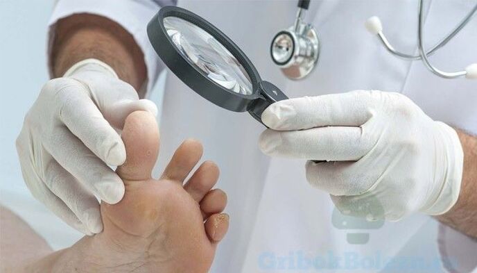 diagnoza glivic na nogah s strani zdravnika