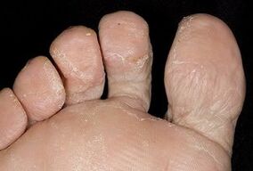 Koža stopal z glivično okužbo