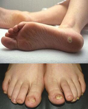 Manifestacije mikoze na koži in nohtih stopal