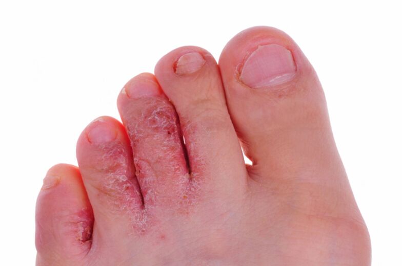 Simptomi rubrofitoze - razpoke in luske na koži nog