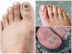 Znaki glivične okužbe nohtov na nogah