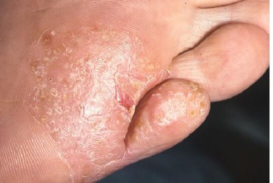 Manifestacije glivične okužbe na koži stopal